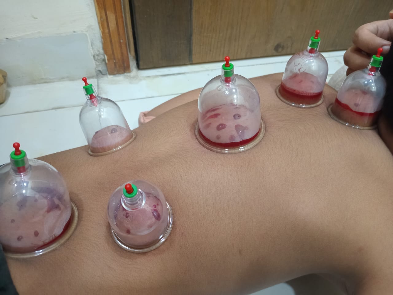 Cupping hijama - Image 3