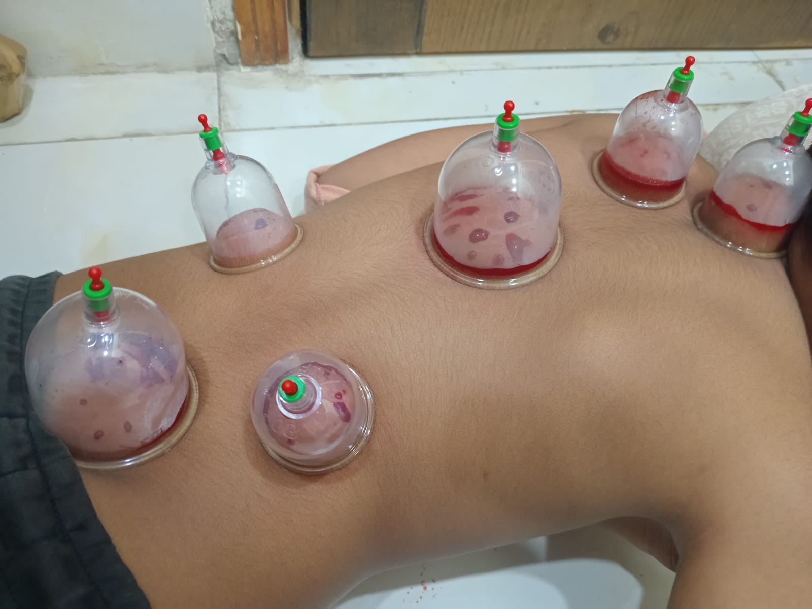 Cupping hijama - Image 2