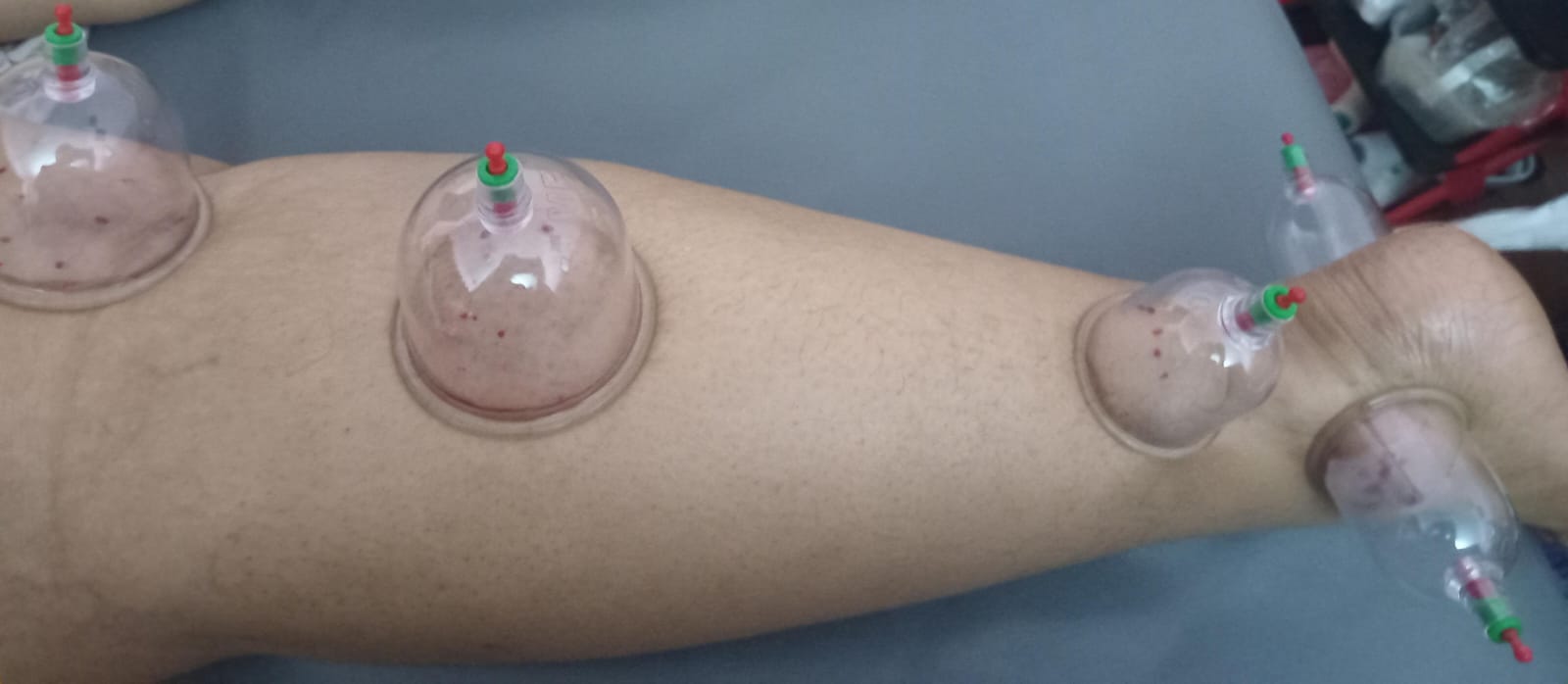 Cupping hijama - Image 5