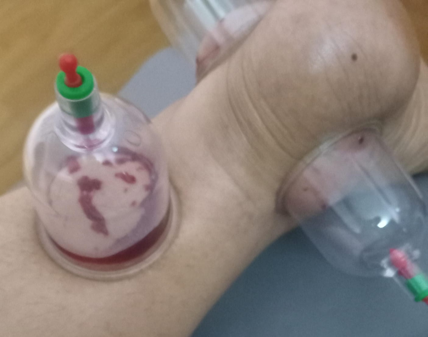 Cupping hijama - Image 4