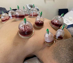 Cupping hijama