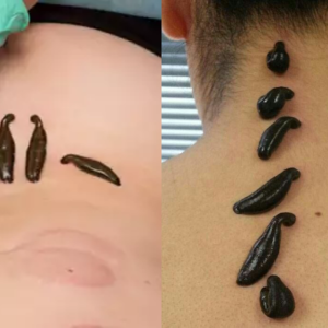 Leech therapy